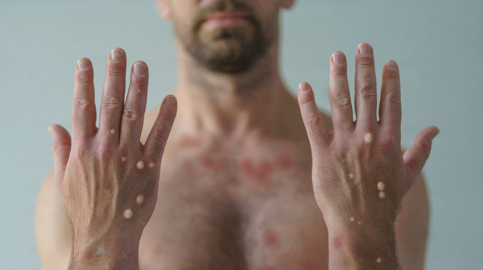 A male hands affected by blistering rash because of monkeypox or other viral infection on white background